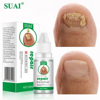 Сива Течност За Ремонт на Ноктите Fungu SUAI Foot Essence Течно Средство За Лечение на Паронихии Премахване на Четки И Стоп Ремонт Противоинфекционный Грижа За Краката